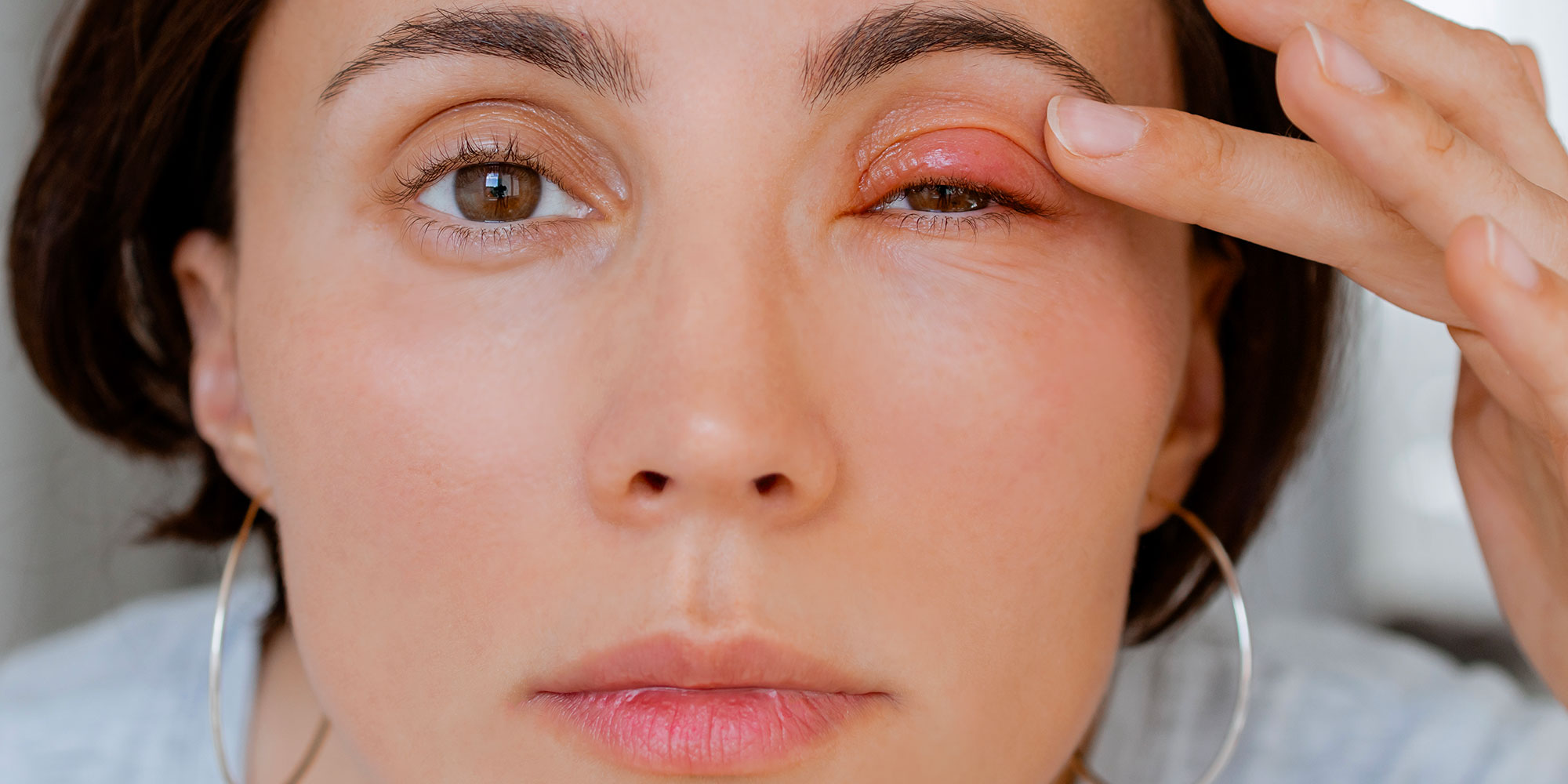 Tout savoir sur le Chalazion